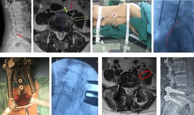 Extreme lateral interbody fusion (XLIF) approach for L5-S1: Preliminary experience